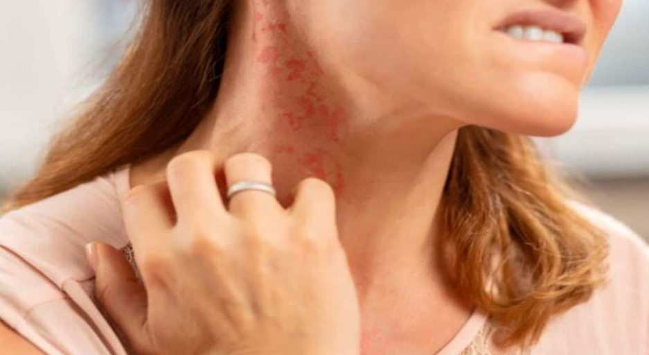 anaphylaxis